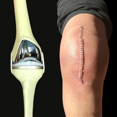 Total Knee Replacement: A Survivor's Guide TKR: A Survivor's Guide ...