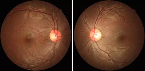 Experimental therapy of One Eye may Improve vision in other in ...