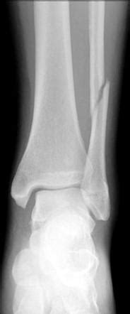 Ankle fracture - Weber C | Image | Radiopaedia.org
