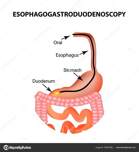 Endoscopy Of Throat And Stomach at Mary Tylor blog