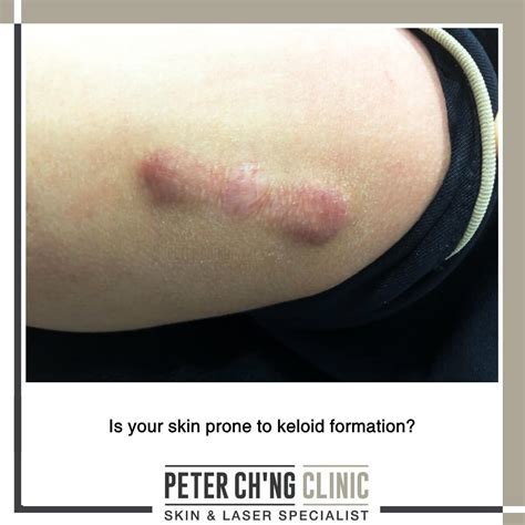 4 Steps to Prevent a Keloid Scar Formation | Peter Ch'ng Skin Specialist - KL, Malaysia