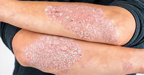 Psoriasis Closely Associated to Higher Risk of Kidney Stones Finds Study