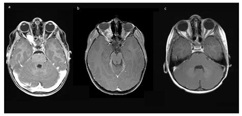 Surgical Management of Pre-Chiasmatic Intraorbital Optic Nerve Gliomas in Children after Loss of ...