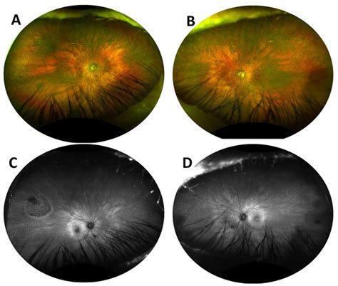 Retinitis Pigmentosa Masquerades: Case Series and Review of the Literature