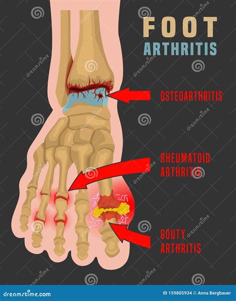 Arthritis Infographic Poster Vector Illustration | CartoonDealer.com #160052850