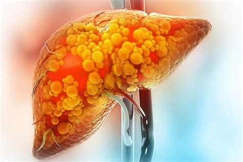 MASH Symptoms: Signs of Metabolic Dysfunction-Associated Steatohepatitis