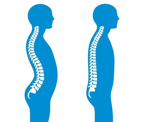 Lordosis Of The Spine