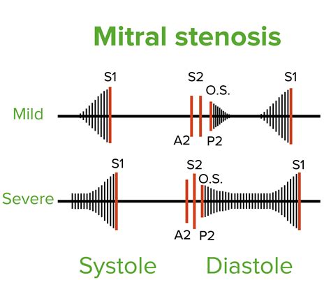 Mitral Insufficiency Murmur Sound Heart Murmur Harvard Health