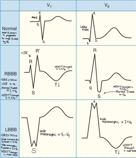 Bundle branch blocks ... Tall R wave ( RSR pattern, M shaped ) in Lead ...