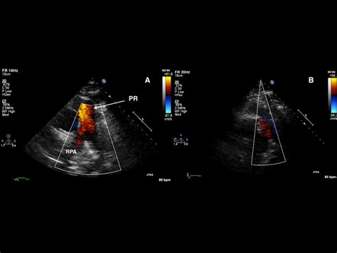 Pulmonic Regurgitation in the Adult Cardiac Surgery Patient - Journal ...