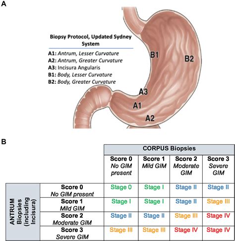 Improving the Endoscopic Detection and Management of Gastric Intestinal Metaplasia Through ...