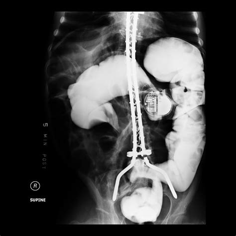 Sigmoid Volvulus Birds Beak