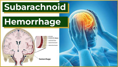 Subarachnoid Hemorrhage - MedEd Cases