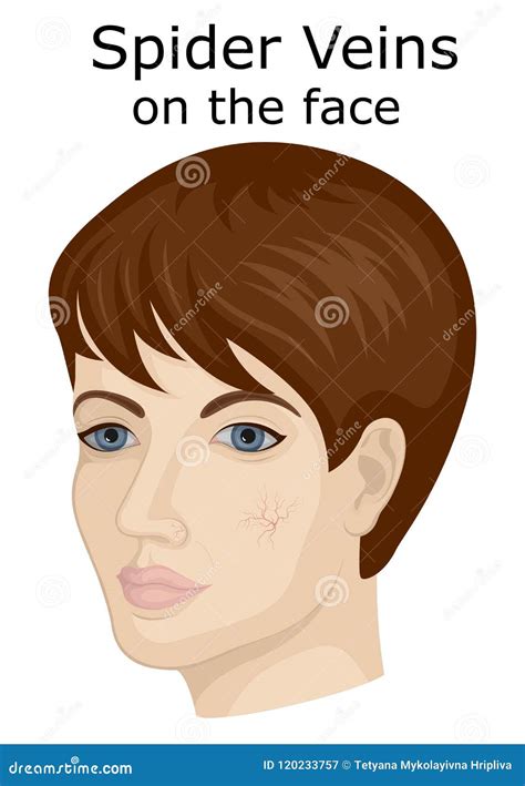 Illustration of the Facial Spider Veins Stock Vector - Illustration of affected, matching: 120233757