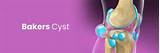 Effective Treatment Options for Baker's Cyst Relief