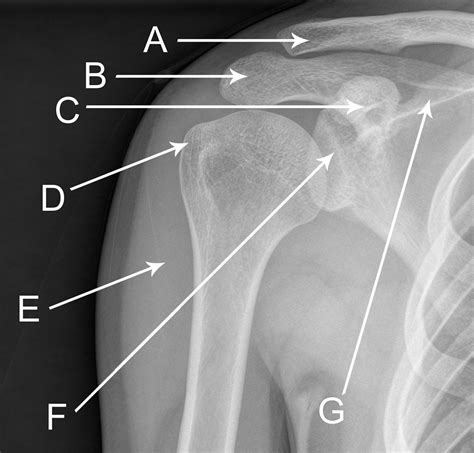 Internal Right Shoulder X Ray