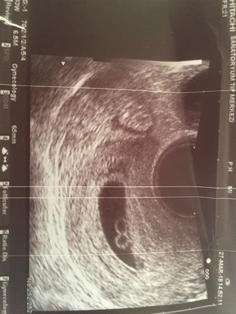 8 Week Ultrasound Fraternal Twins