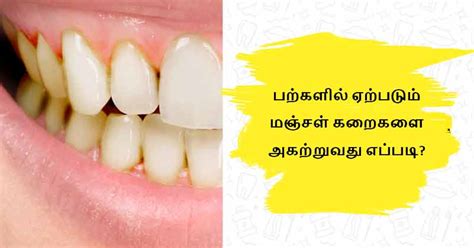 7 simple remedies to get rid of yellow stains on teeth in tamil