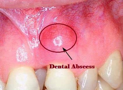 Bildergebnis für abscess tooth popped in mouth