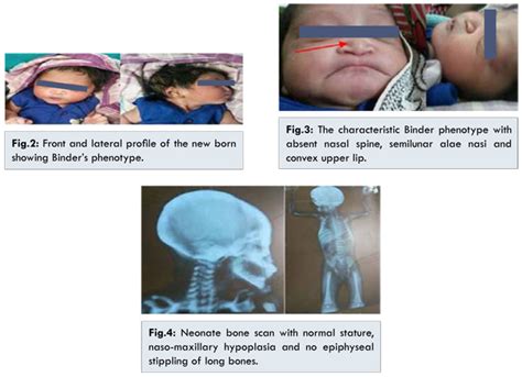 Antenatally Diagnosed Binder Syndrome in Newborn Following Maternal ...