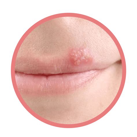 Cold Sore On Lower Lip