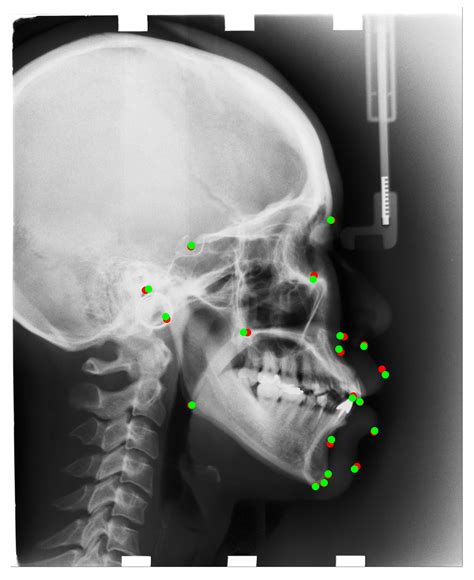 Automatic Cephalometric Landmark Detection on X-ray Images Using a Deep ...