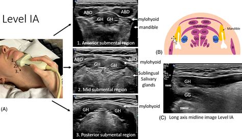 Sonographic localisation of neck lymph nodes using surgical neck level classifications - Fenech ...