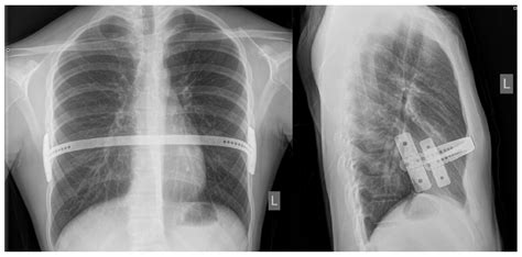 Minimally Invasive Modified Nuss Procedure for Repair of Pectus ...