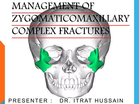 Management of zygomaticomaxillary complex fractures ih | PPTX