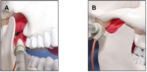 Botulinum Neurotoxin Injection for the Treatment of Recurrent ...