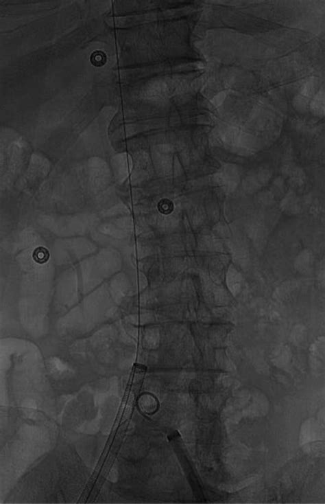 Retrieval of an inferior vena cava Greenfield filter 34 years after insertion | BMJ Case Reports