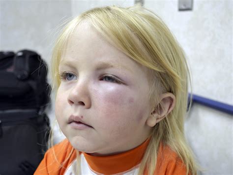 What to do if your baby has a swollen eye | BabyCenter