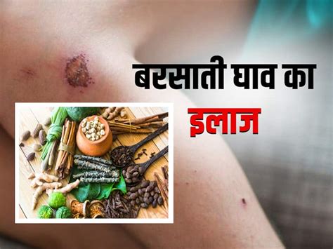 बरसाती घाव का घरेलू उपचार: इस्तेमाल करें ये 5 जड़ी बूटियां | Barsati ...
