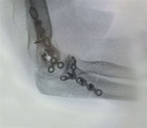 Open Reduction & Internal Fixation Surgery for Fractures