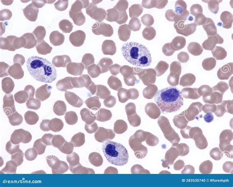 Congenital Pelger–Huët Anomaly. Stock Photo - Image of blood, laboratory: 283530740