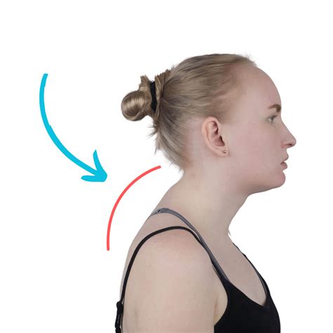 What is a Dowager’s hump (Kyphosis)? - York Rehab Clinic