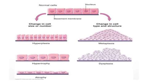 Cell adaptations.pptx/ hypertrophy/ atrophy/ dysplasia/ metaplasia ...