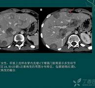 Image result for 血管内皮瘤