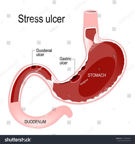 Peptic Ulcer Disease Gastric Duodenal Ulcer Stock Illustration ...