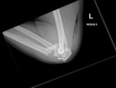 Fractures Around the Elbow | Dr Oscar Brumby-Rendell | Orthopaedic Surgeon
