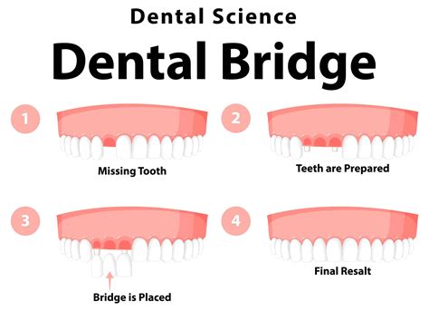 Front Tooth Crown Before And After 1 Porcelain Crown On Upper Front