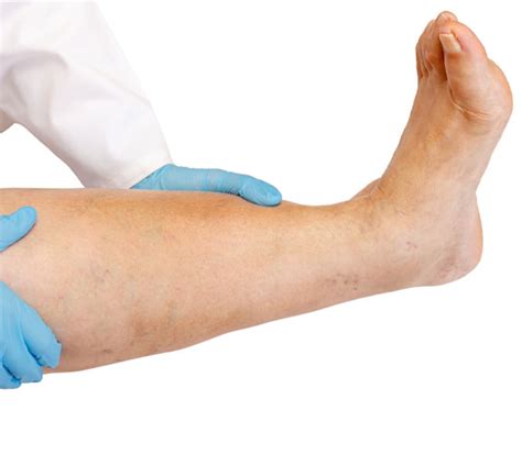 Peripheral Vascular disease treatment in Chennai