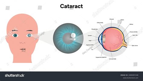 Vision Disorder 的图像结果