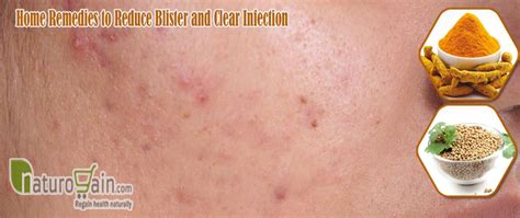 Image result for Big Zits Exploding at Home