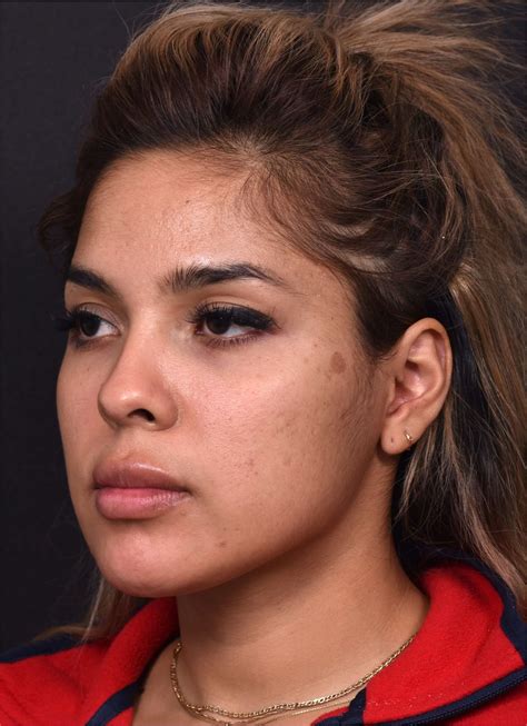 Buccal Fat Reduction Case 16506