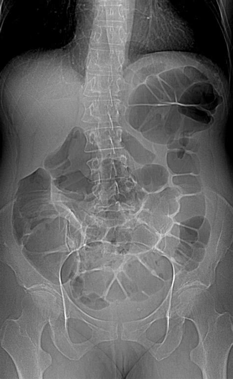 Detection of Occult Colonic Perforation Before CT Colonography After Incomplete Colonoscopy ...