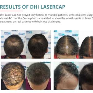 Buy DHI Laser Cap with 108 Laser Diodes | US FDA Approved & Clinically ...