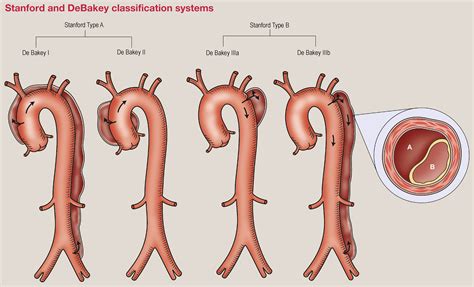 Aortic Dissection Vs Acs at Judy Roybal blog