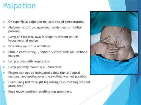 lump in abdomen (2).pptx