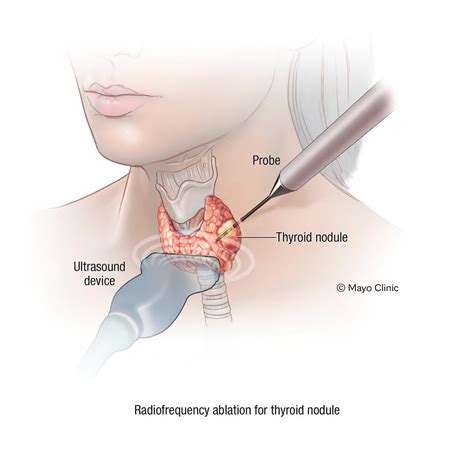 Thyroid Lump Efficacy Of Radiofrequency Ablation In Autonomous